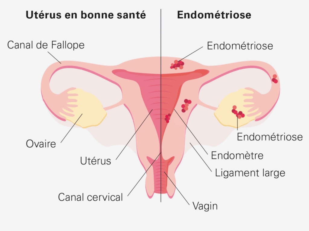 Endométriose : une maladie fréquente encore trop méconnue comparaison d'un utérus sain et d'une endométriose