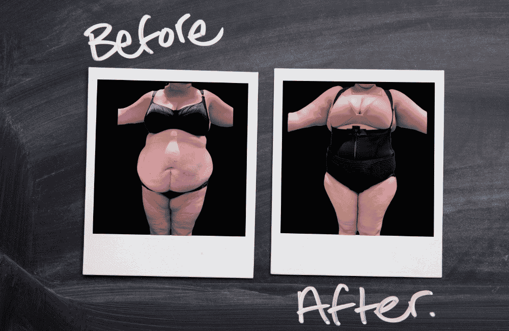 Notre service : Ceinture abdominale sur-mesure avis lipoline de anna