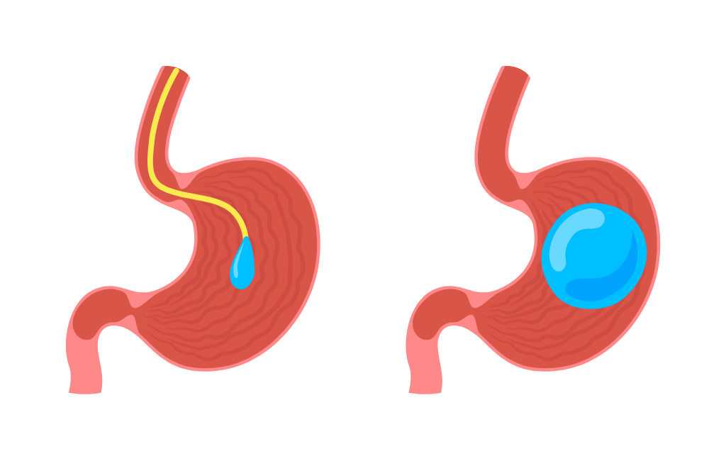 ballon gastrique