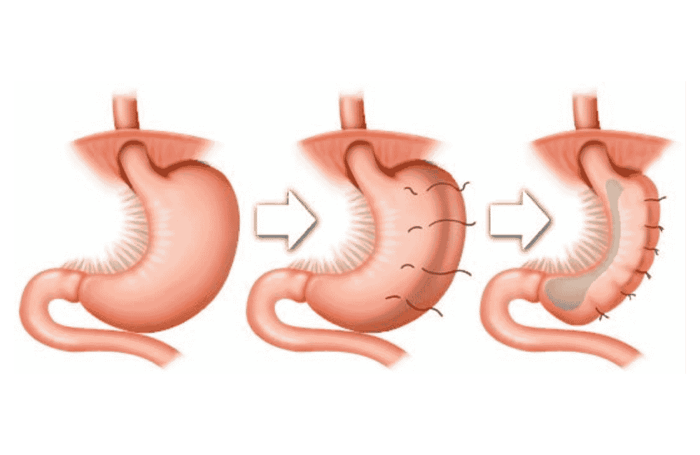 endosleeve