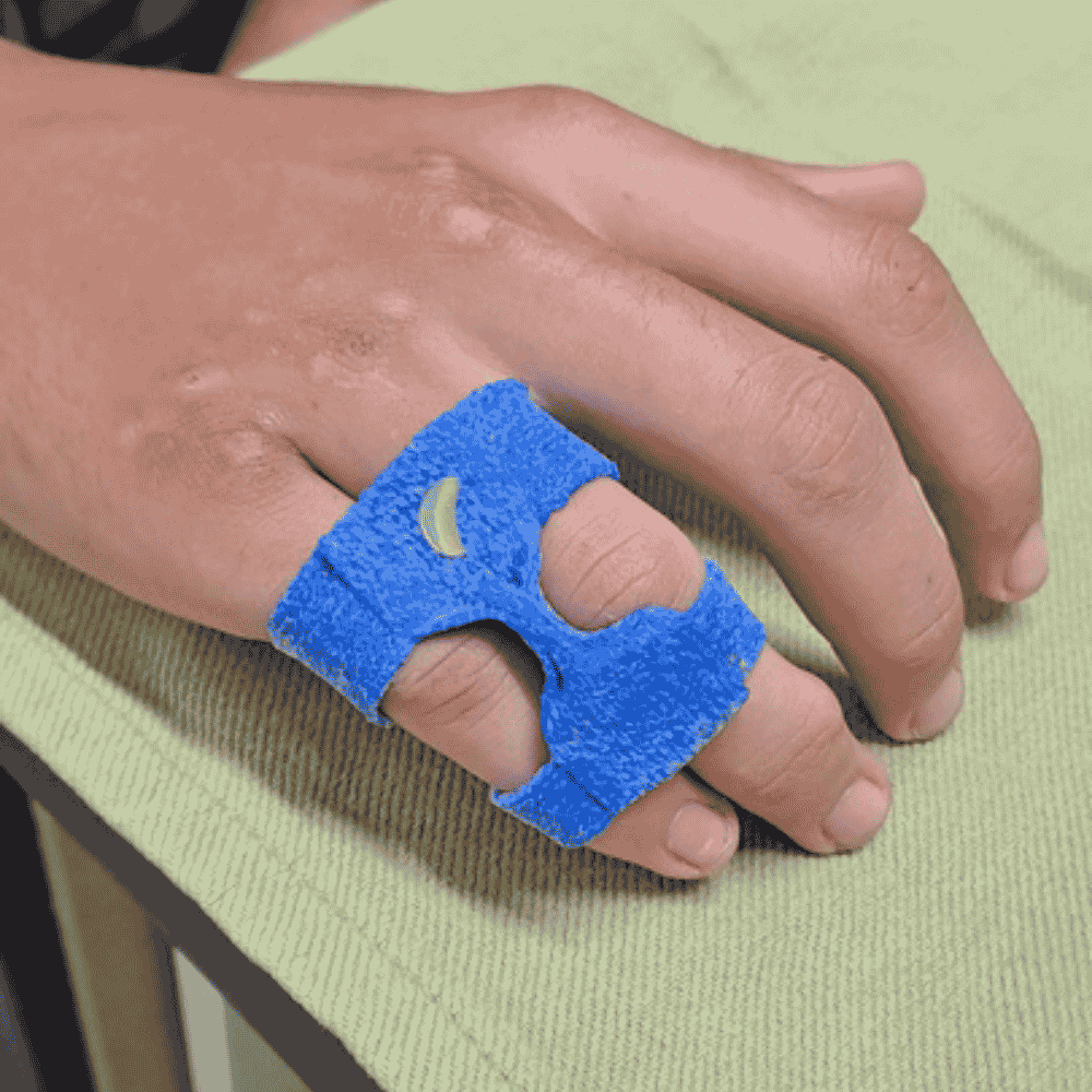 syndactylie